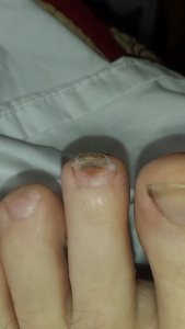 I've seen much worse that this on other hikers. It's the toe underneath not the nail that's black. Eventually the tip of my toe shriveled up and fell off. 